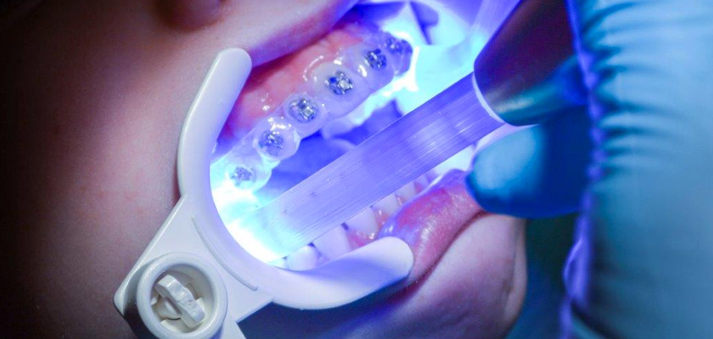 thumbnail interactive-video image 1 of 10 Kits / 40 Pcs Dental Orthodontic Plain Molar Bands – U1/L1 1st #29-44+ 1 of 5